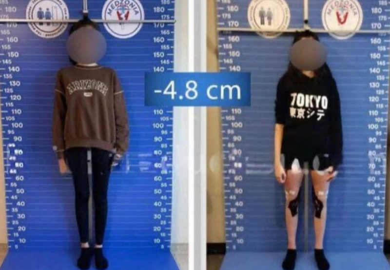 Девушки в Стамбуле укорачивают ноги, чтобы нравиться мужчинам — новый тренд с рисками